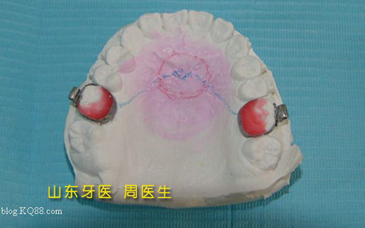 nance弓正畸技工制作图谱