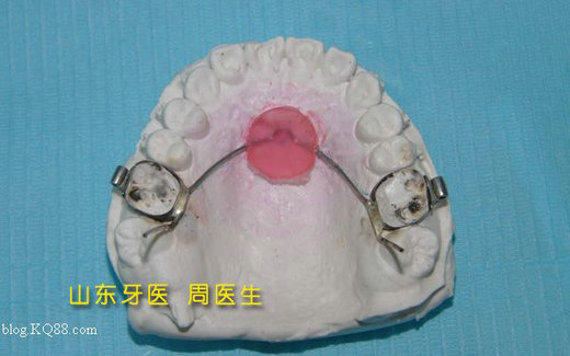 nance弓正畸技工制作图谱